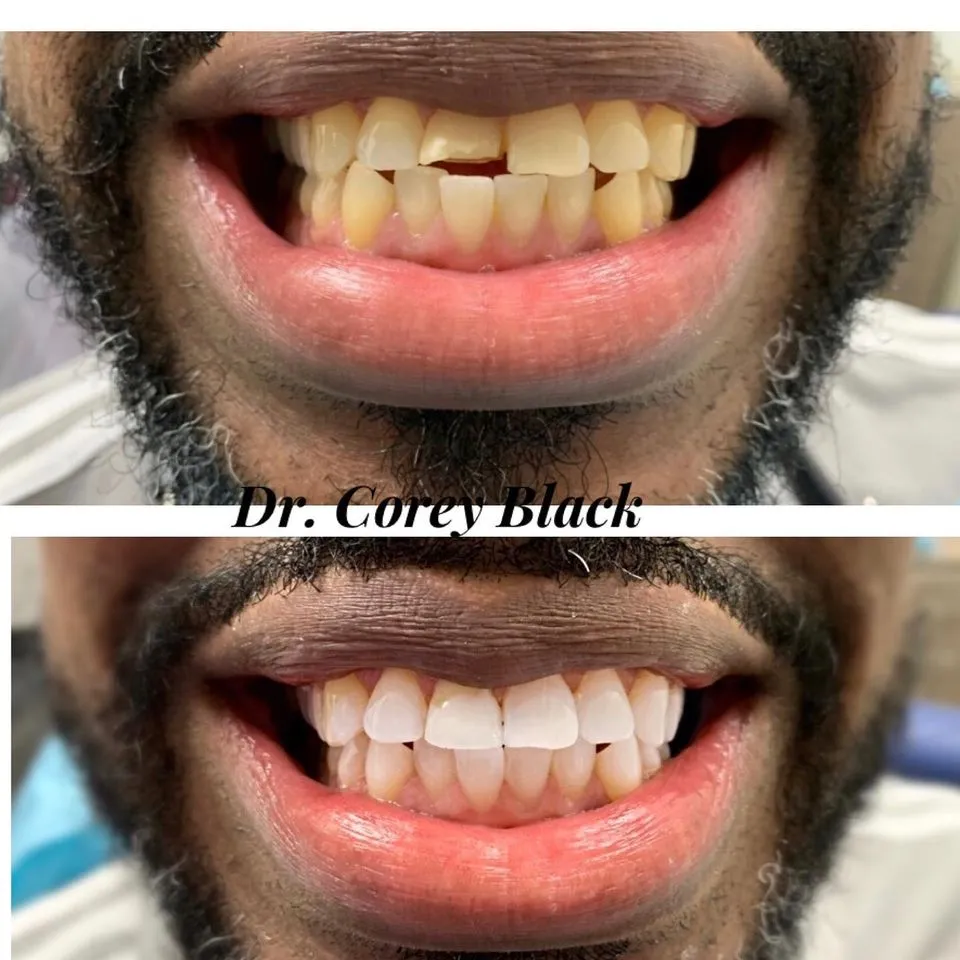 Patient smile transformation at SmileSpace