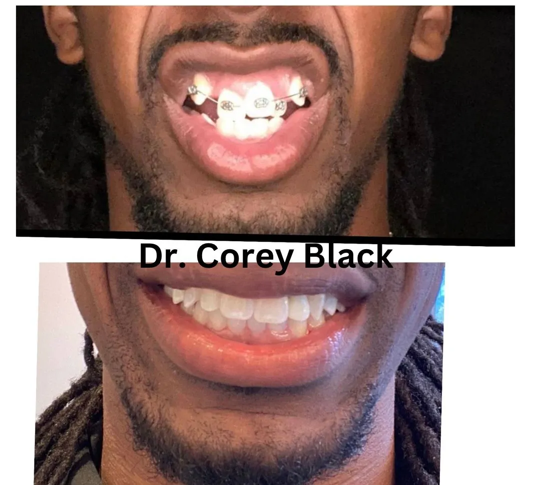 Patient smile transformation 7 at SmileSpace