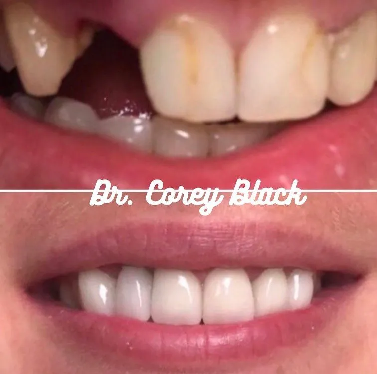 Before and after dental treatment at SmileSpace