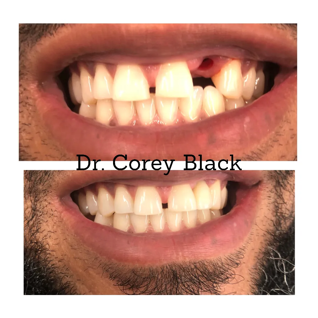 Patient smile transformation 3 at SmileSpace