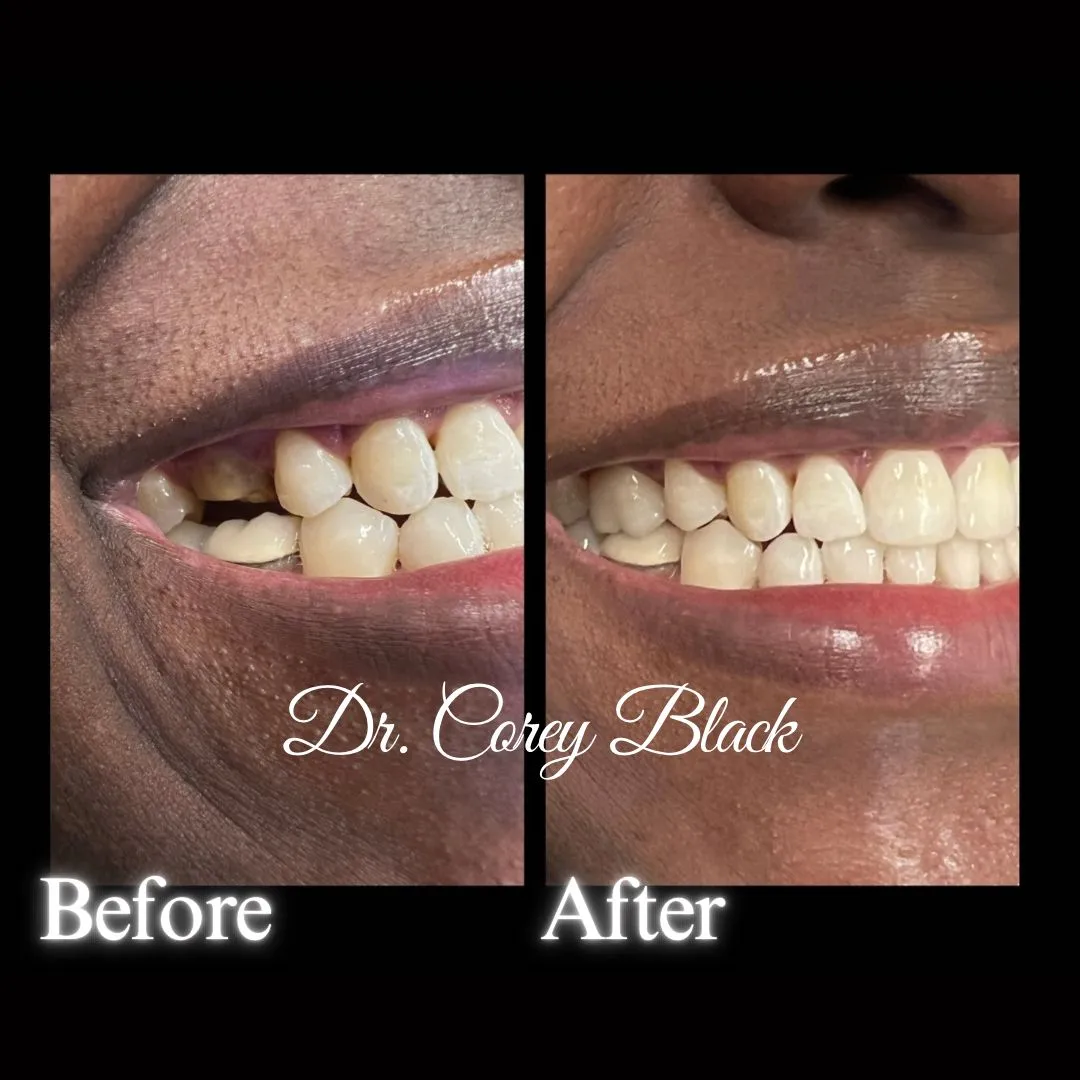 Patient smile transformation 8 at SmileSpace