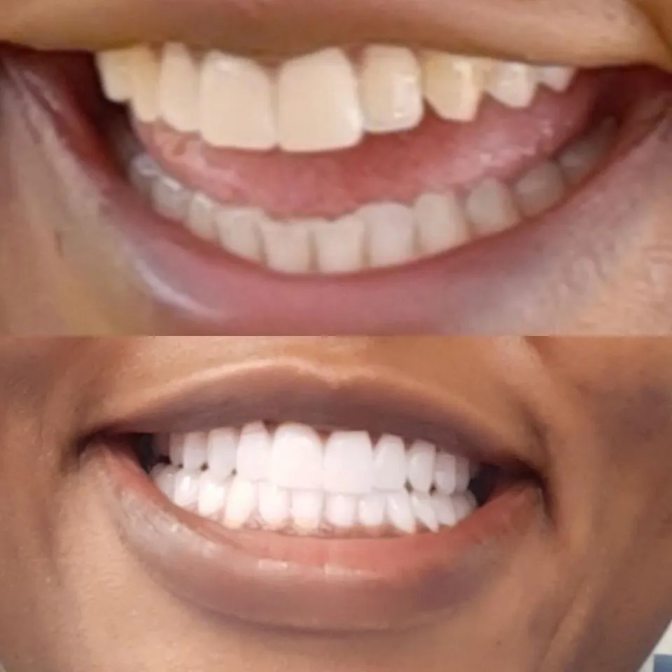 Beautiful smile transformation at SmileSpace