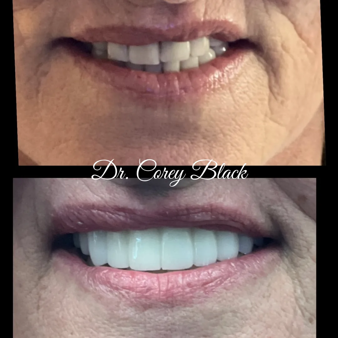 Patient smile transformation 6 at SmileSpace