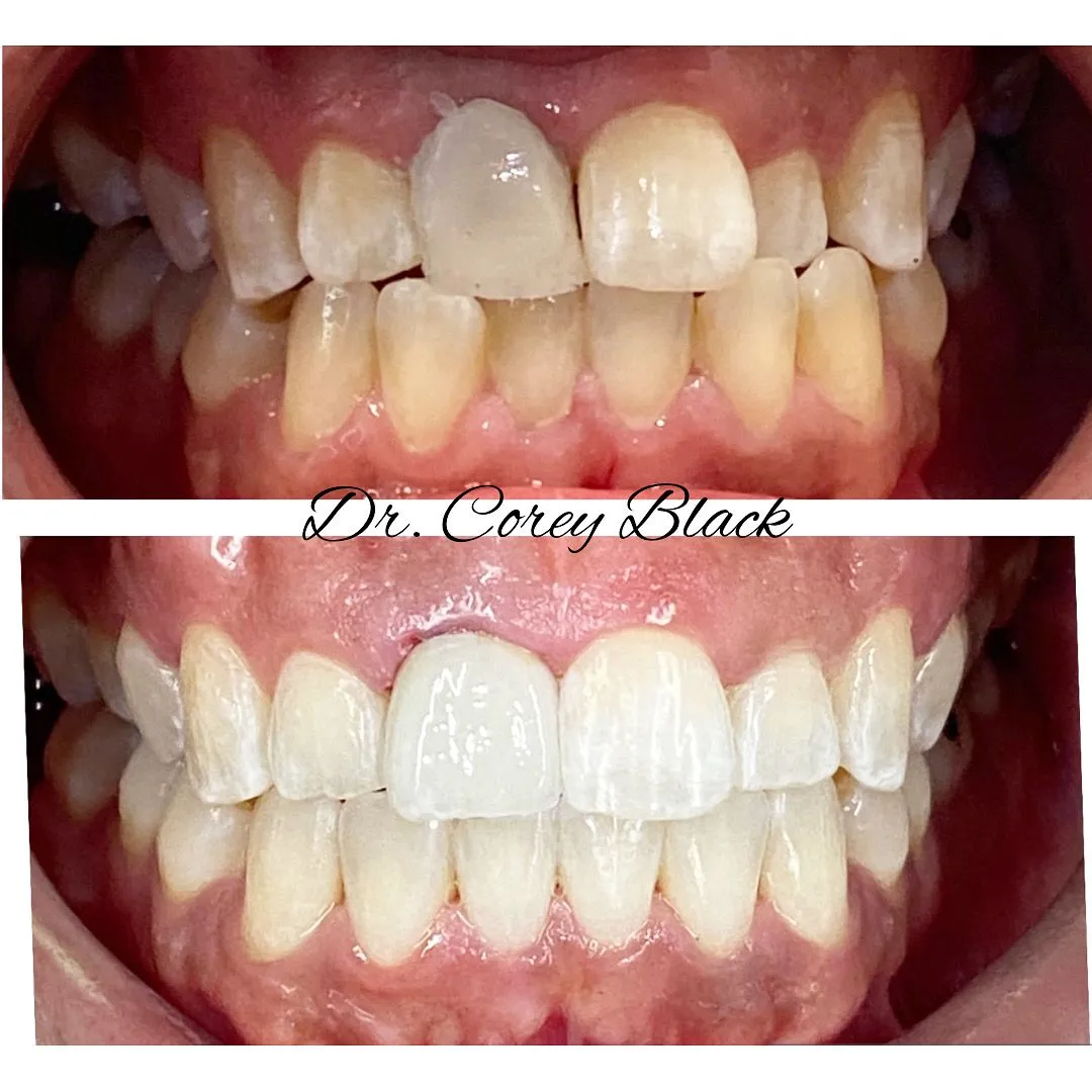 Patient smile transformation 9 at SmileSpace
