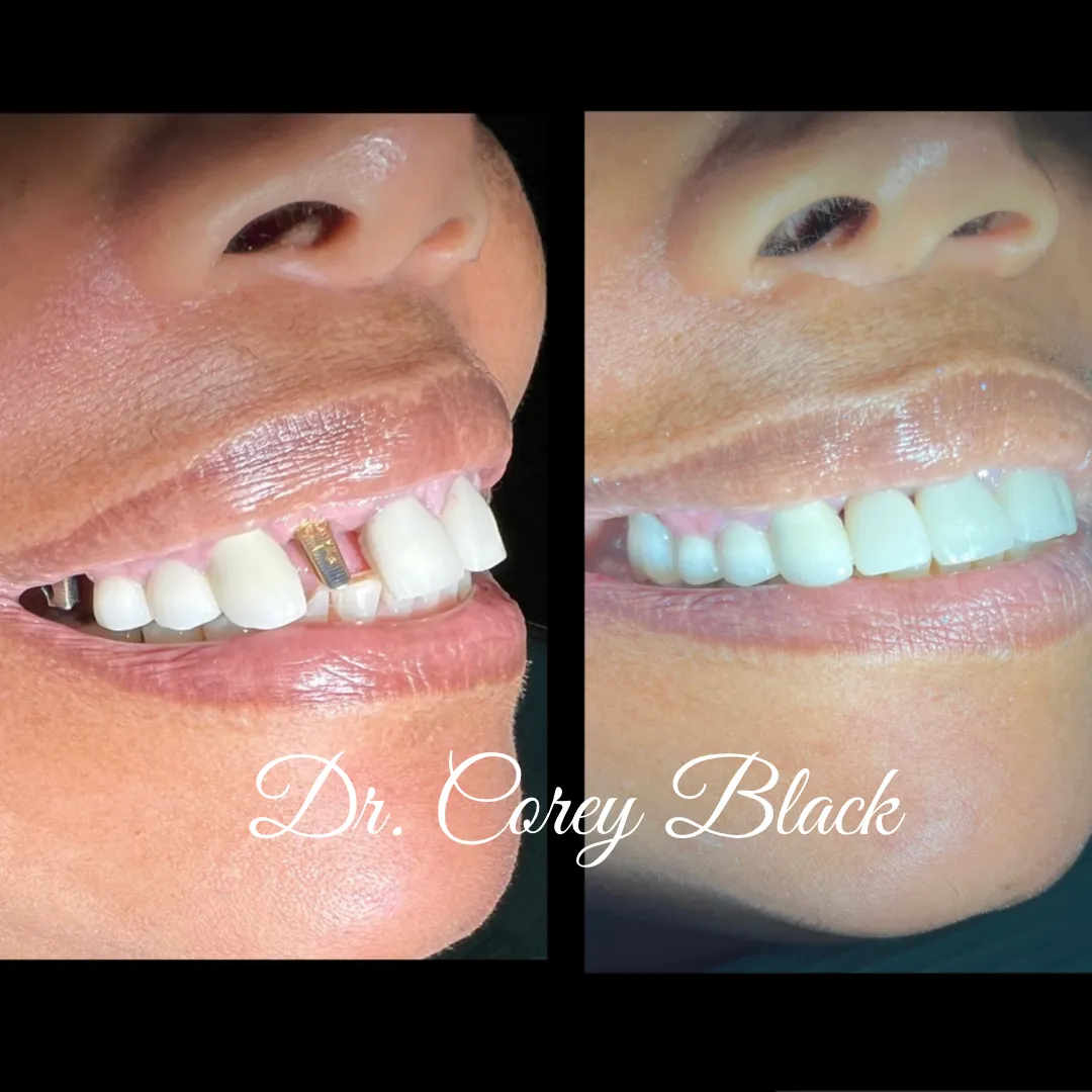 Patient smile transformation 10 at SmileSpace