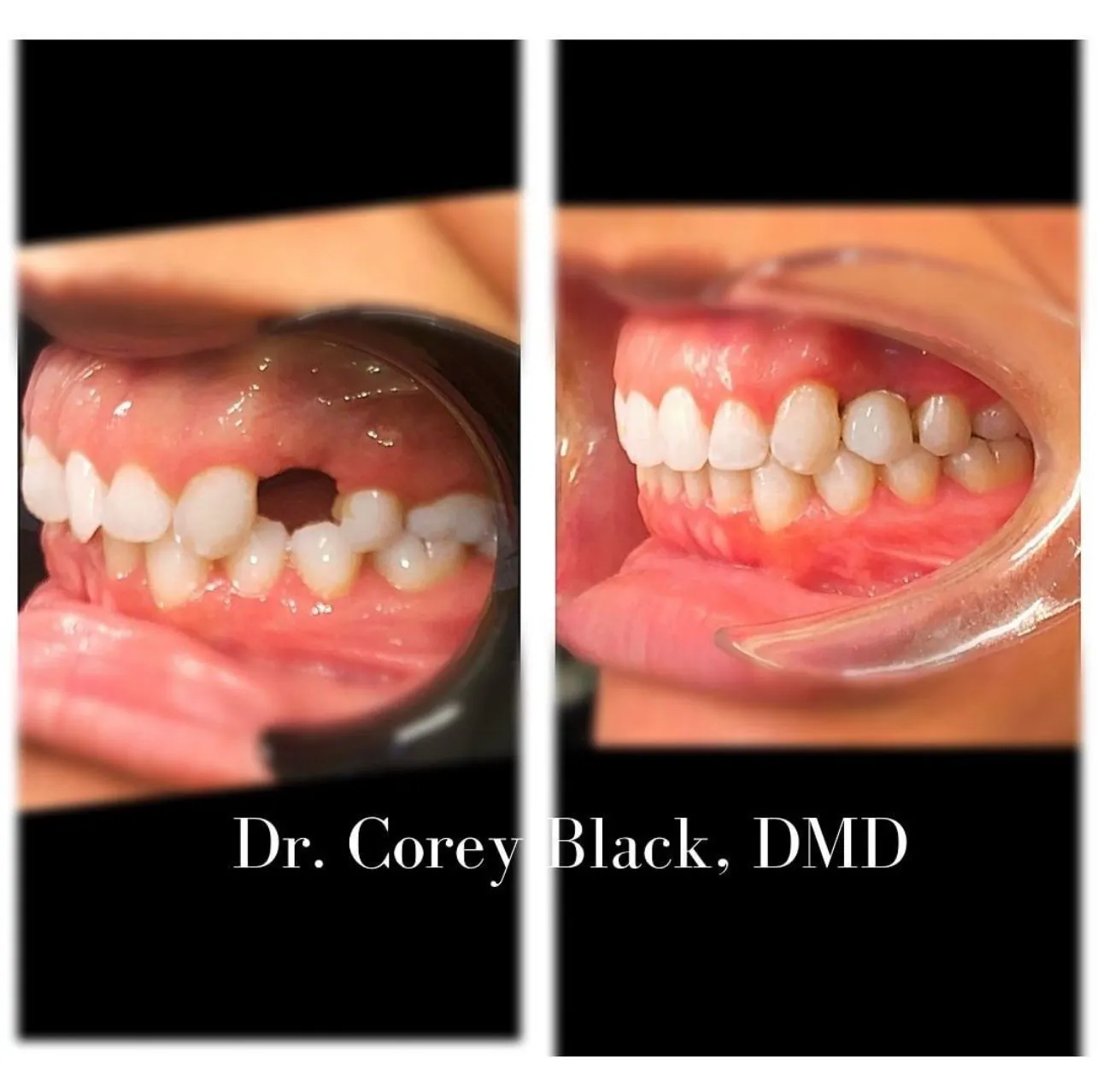 Patient smile transformation 11 at SmileSpace