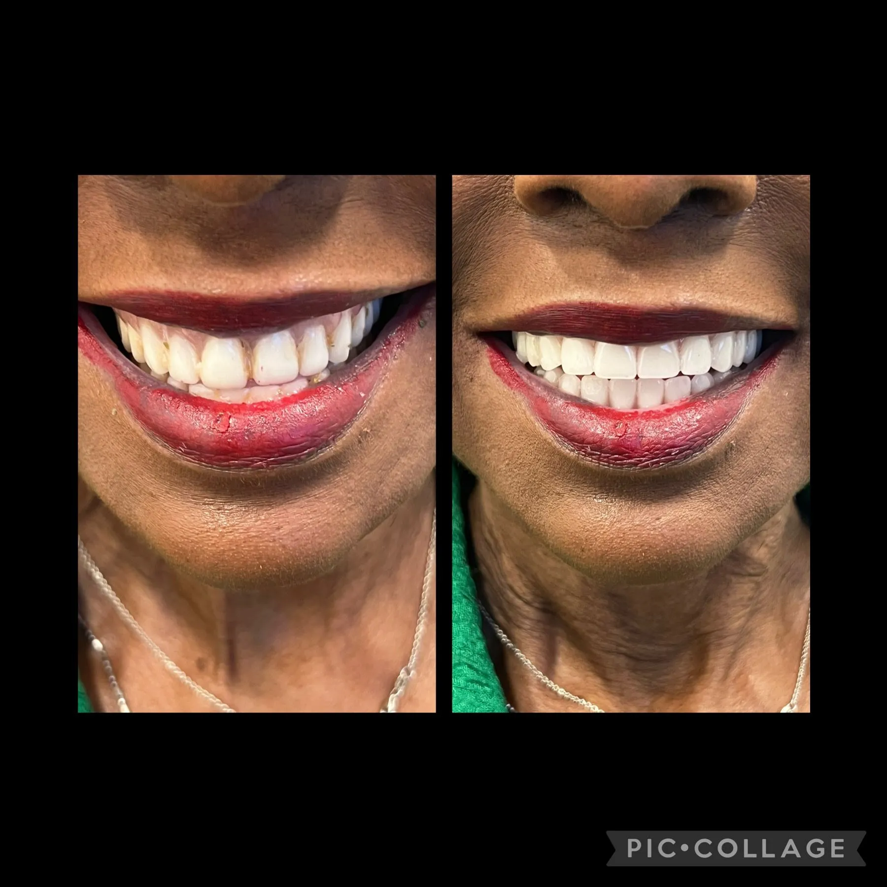 Patient smile transformation 12 at SmileSpace