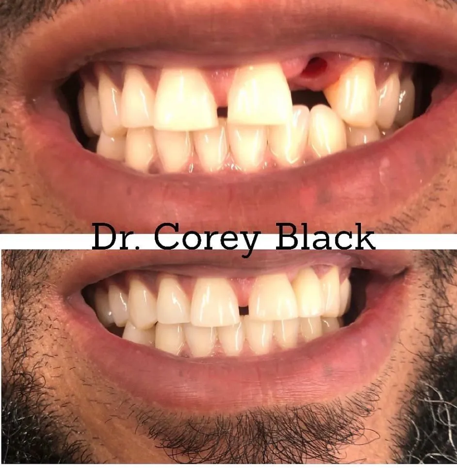 Patient smile transformation 15 at SmileSpace