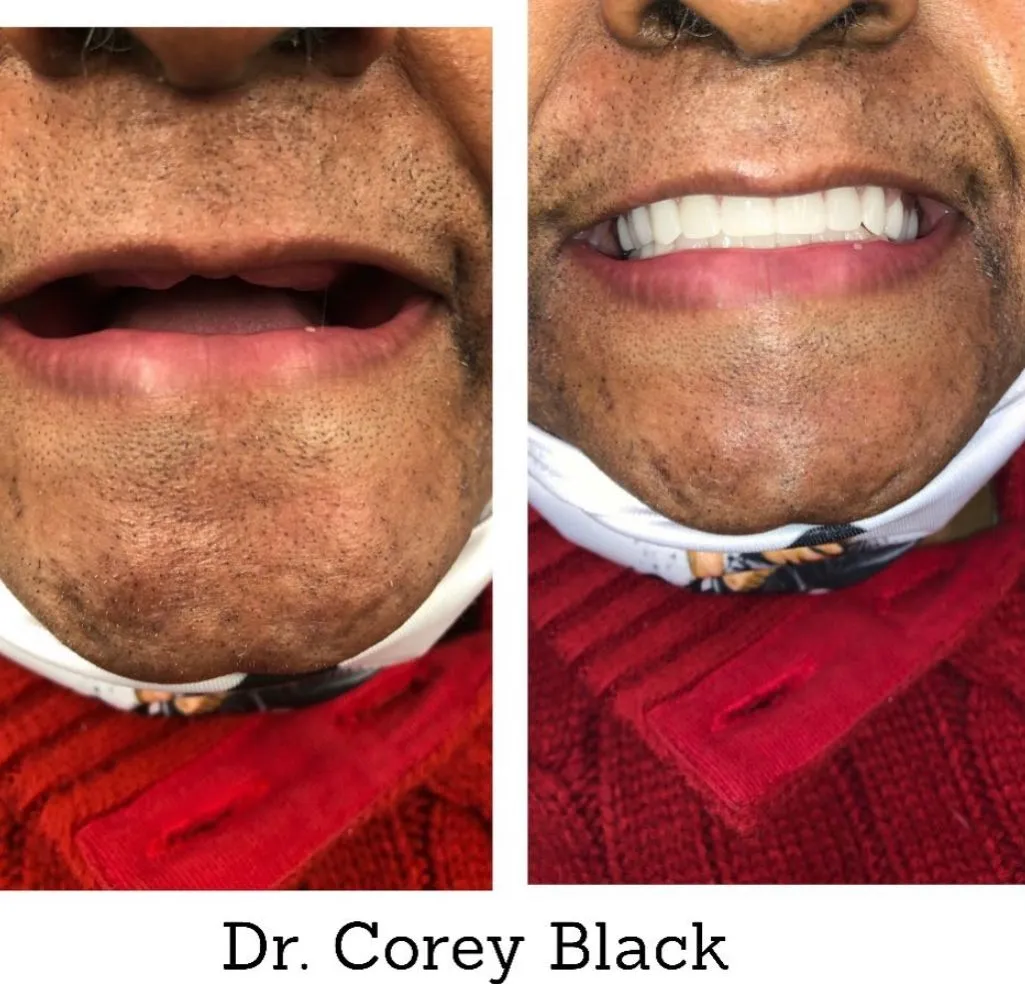 Patient smile transformation 17 at SmileSpace