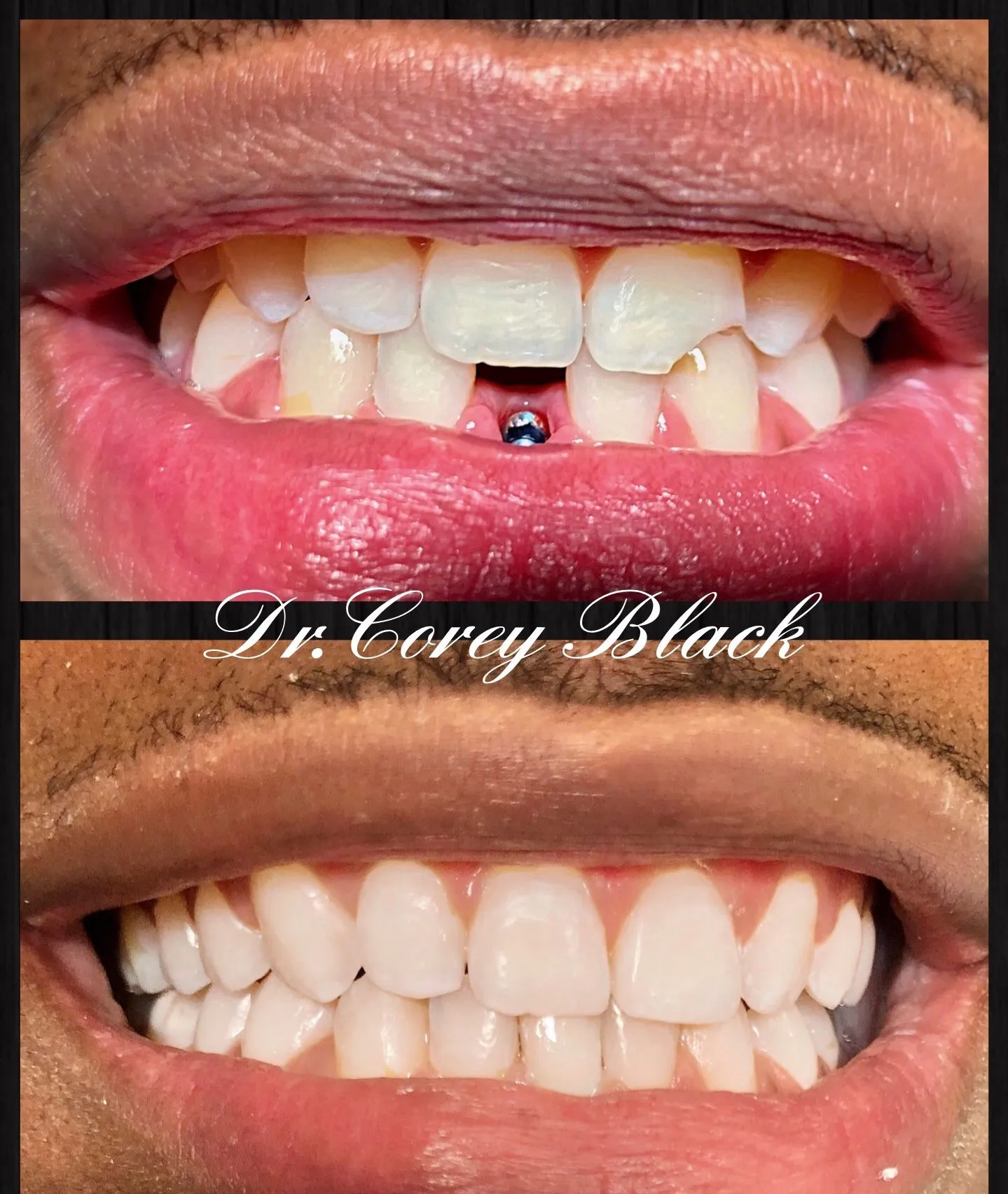 Patient smile transformation 18 at SmileSpace