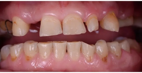 Before - Smile transformation